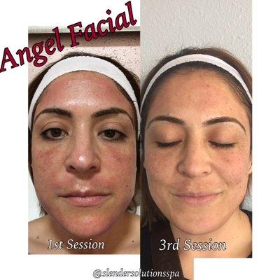 (PRP) Angel Facial