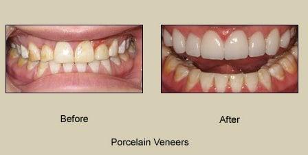 Porcelain Veneers (Upper teeth)