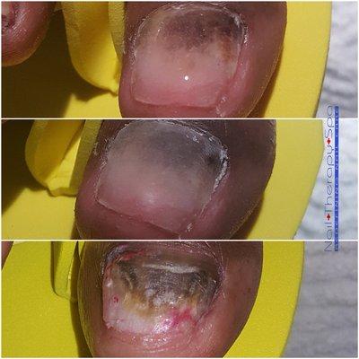 Before and after picture of "nail reconstruction service" for a client that had nail partially removed due to fungus