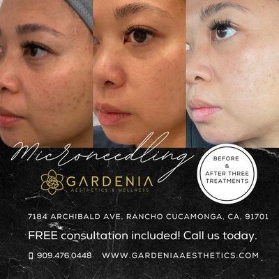 Before and after 3 stem cell microneedling treatments