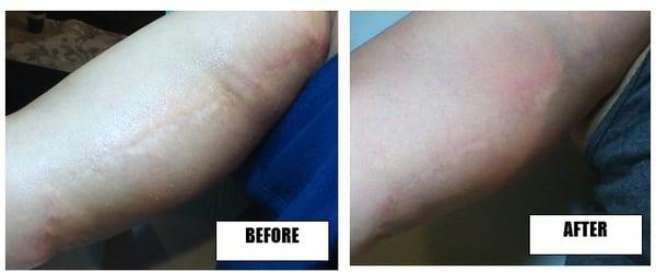 Surgical scars before and (2 months) after one skin needling session. Usually takes about 3-4 months for full effect to be seen.