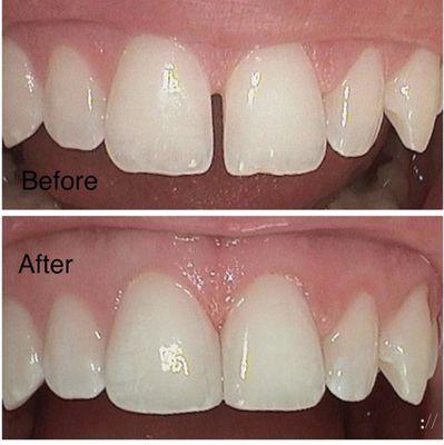 The gap is closed using direct composite white filling in less than 30 minutes.