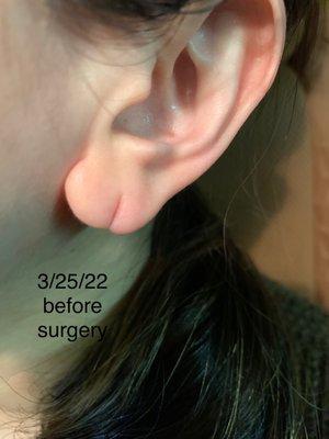 Scheduled for earlobe repair surgery