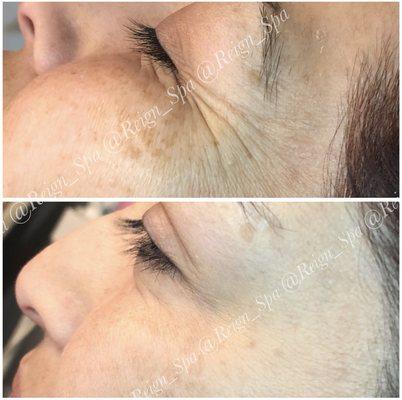 Before and after crows feet treated with Dysport