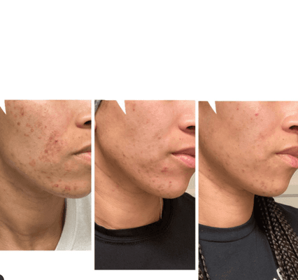 Results after two professional facials and professional home care products