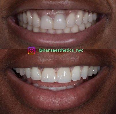 Hans Aesthetics Dental lab Aesthetics Porcelain veneers, cosmetic dentistry Aesthetic dental lab nyc dental lab feldspathic veneers