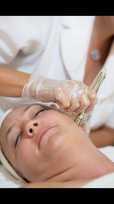 Microdermabrasion