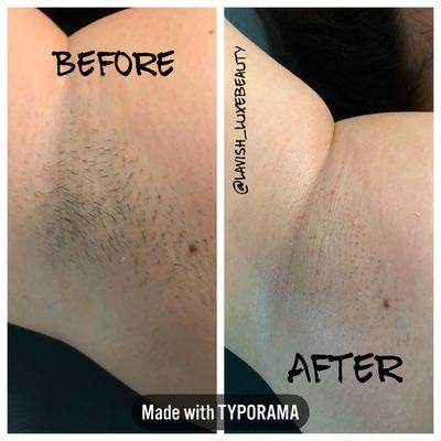 Before & after photos of an underarm waxing. I used @starpilwax pink polymer wax for a painless wax experience.