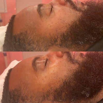 Microneedling before and after