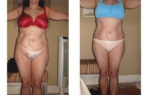 No Lipo Lipo before and after