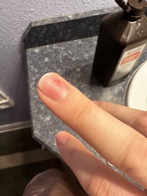 Day after nail damage