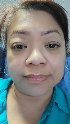 Another post Facial photo. Very satisfied with session, blackheads and whiteheads removal and cryotherapy!