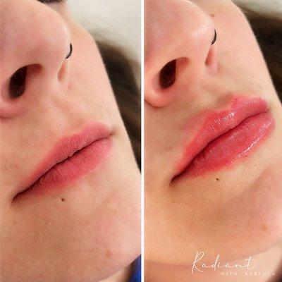 Versa Lip Filler - Radiant with Rebecca Med Spa