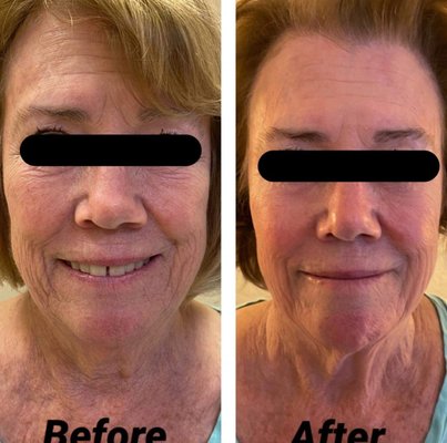 8 Point Face Lift without needles