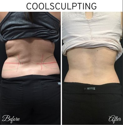 CoolSculpting treatment before and after results.