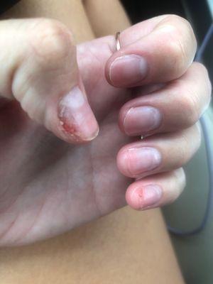 Two bleeding and ripped finger nails..