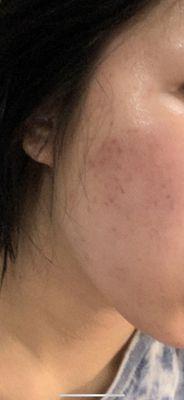 Bad acne scars