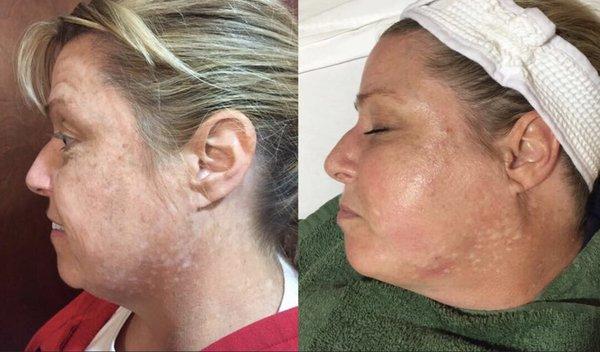 Triple transformation peel.