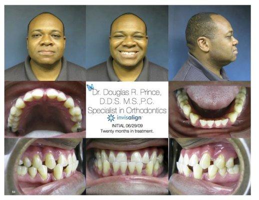 Spacing  Before Invisalign Adult