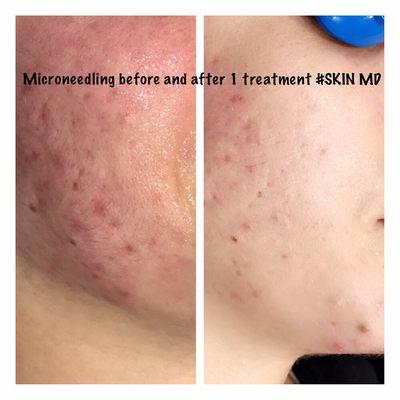 Microneedling