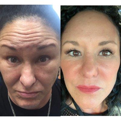 Before and after Botox and Fillers.