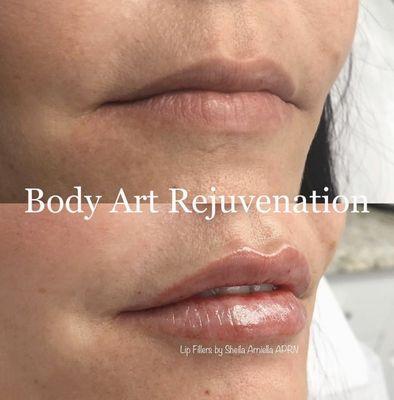 Right after lip filler injections. Sheila Arniella NP.