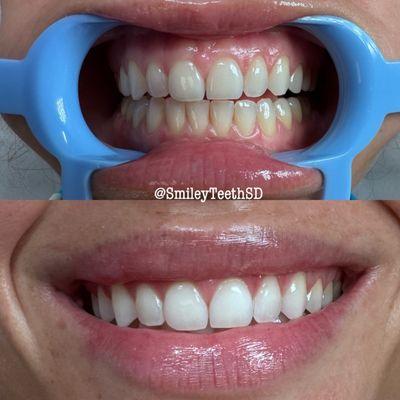 Teeth Whitening Results