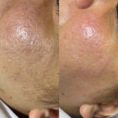 Dermaplaning with Signature Hydrafacial BEFORE and AFTER