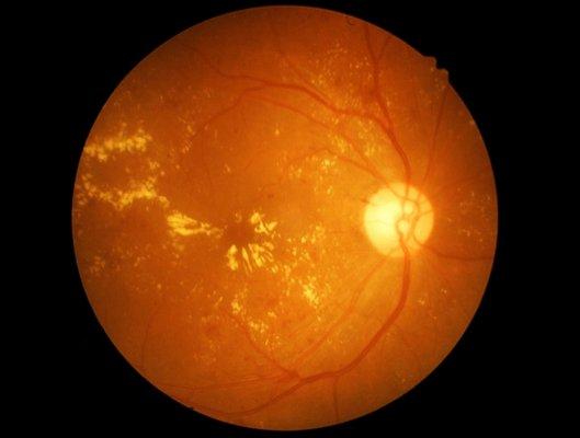 Our NO-COST retinal photos provide a detailed view of the back of the eye. Get checked for Glaucoma and Macular Degeneration yearly.