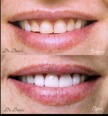 Teeth Whitening - Larwin Square Dentistry Tustin