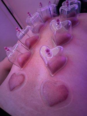 Heart cupping therapy