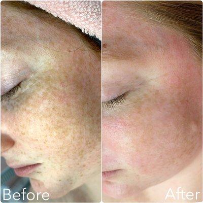 Dermaplan before and after