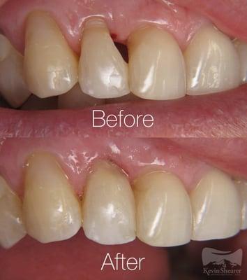 This patient came in with a diastema, walked out with a smile she felt comfortable with.  Better yet, no drilling or anesthetic needed.