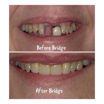 Before and after smile makeover for our patient.