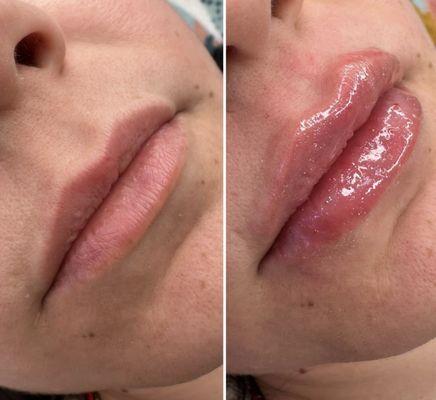 1.5 ML Lip Filler