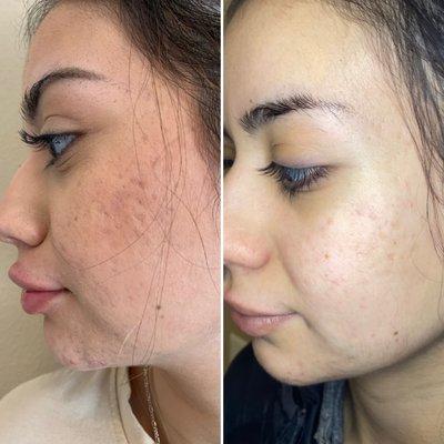 Microneedling