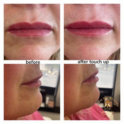 lip filler touch up for a little more plumpiness