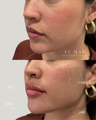 Facial Balancing with dermal fillers. Areas of treatment: Cheeks, Jawline, chin, lips