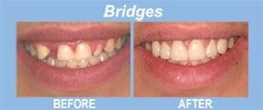 Bridges can fill gaps where more than one tooth is involved, or when adjacent teeth can also benefit from improvement...