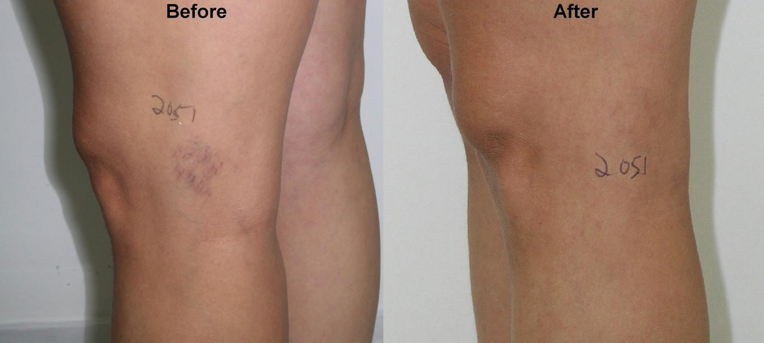 Fort Lauderdale Varicose & Spider Vein Clinic